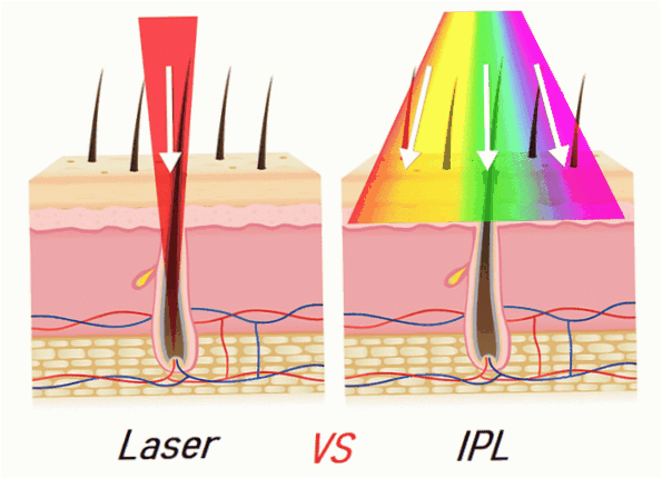 laserová a fotoepilace