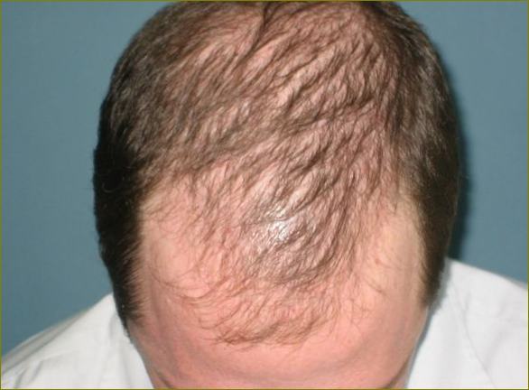 Androgenní alopecie