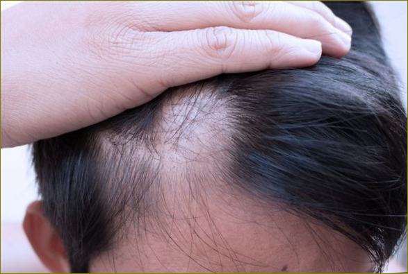 difúzní alopecie