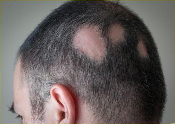 Fokální alopecie