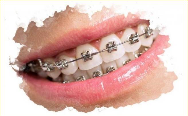 Zařízení pro vyrovnání zubů
